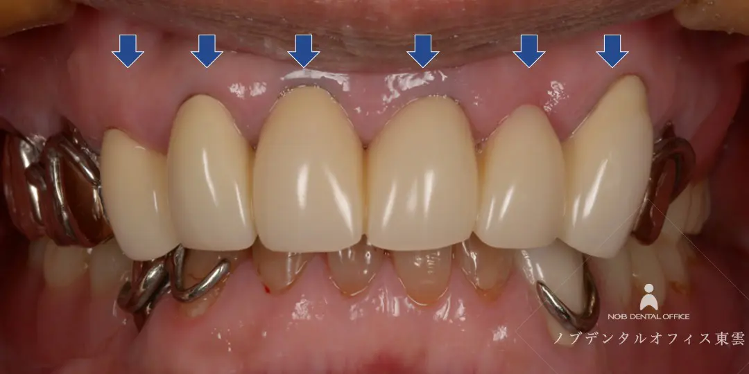 他の部位にも二次虫歯があり、治療のやり直しを行った写真