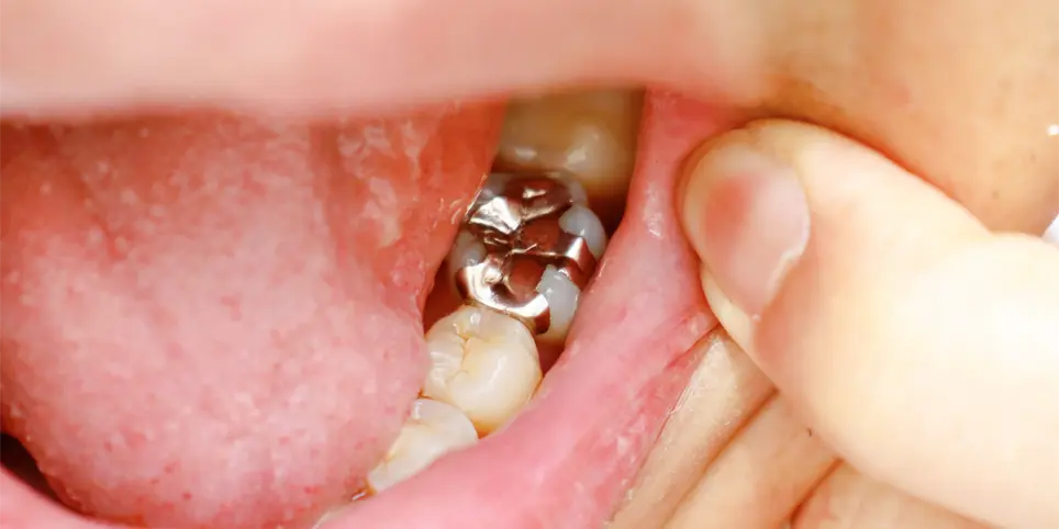 歯の修復治療で、メタルインレーを入れた写真