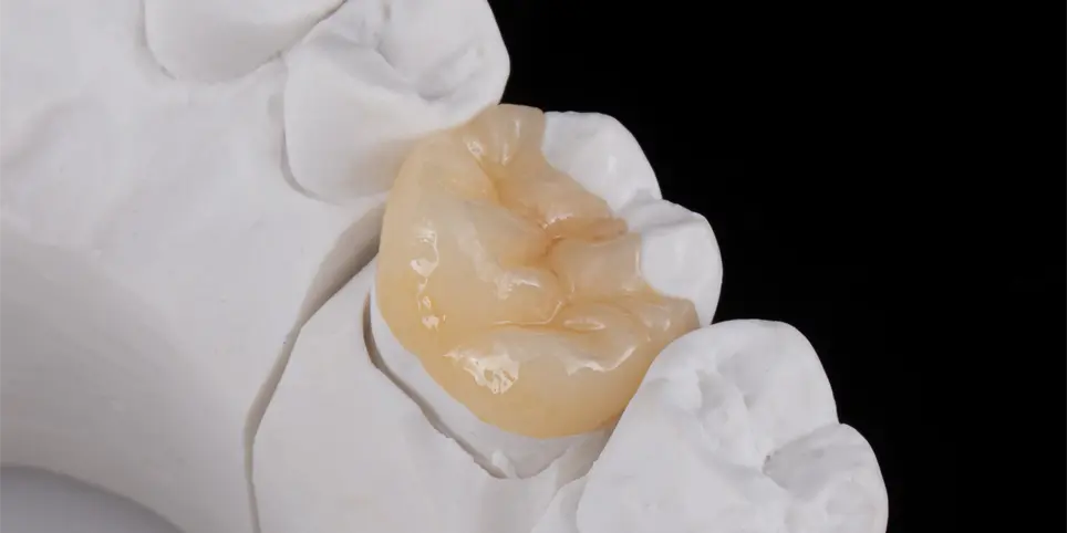 歯の修復治療で、セラミック・ガラスセラミックのインレーを入れた写真