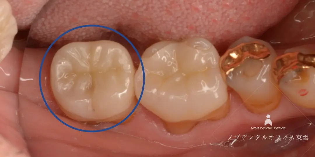 オクルーザルベニア修復の素材の写真(奥歯)