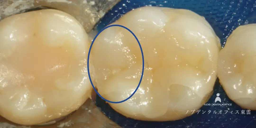 インレー修復のセラミック・ジルコニア系の写真