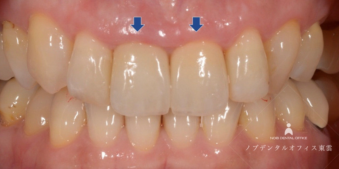 クラウン修復の素材で、セラミック - ジルコニア系の写真