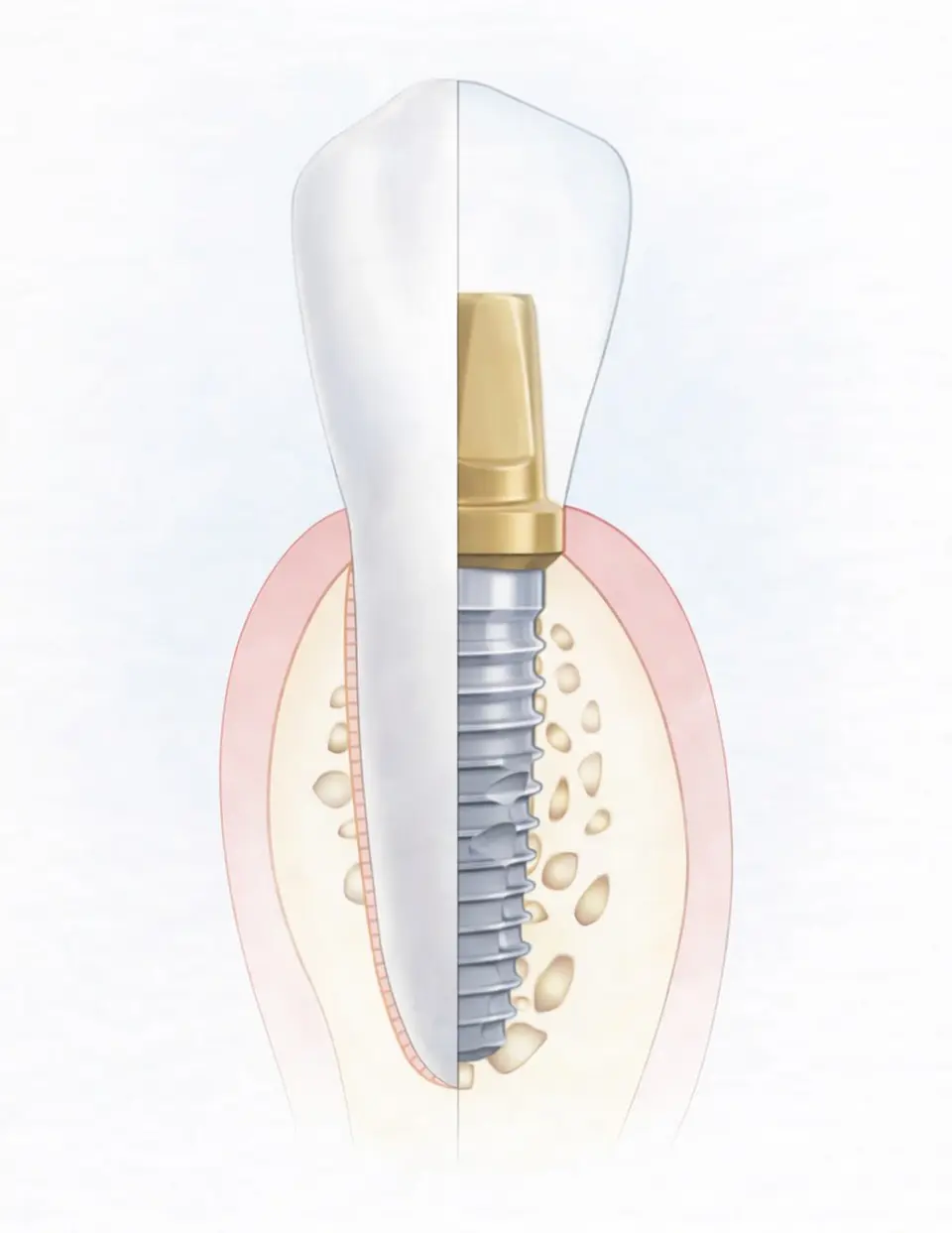 インプラントのイメージ