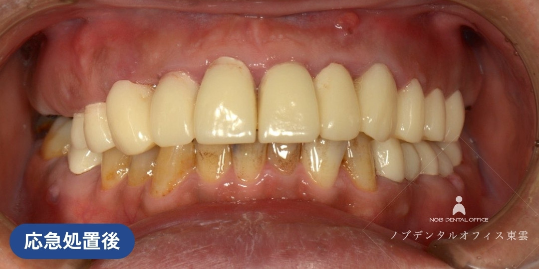 初診のあと、応急処置で仮歯を設置した状態の写真