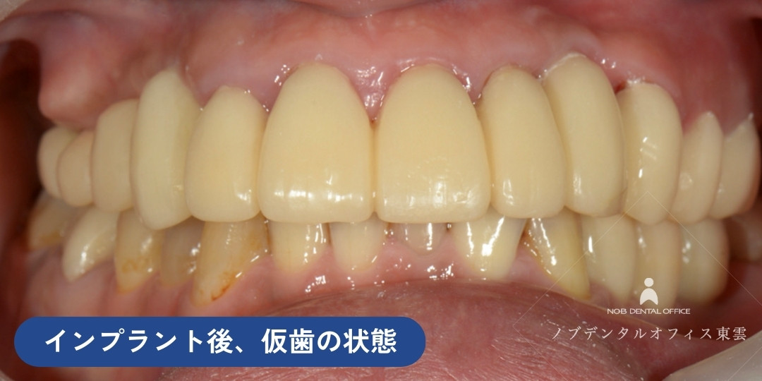 親知らずを含め、ご自身の保存が難しい10箇所について抜歯。7本のインプラントをいれた後、仮歯をセットした写真