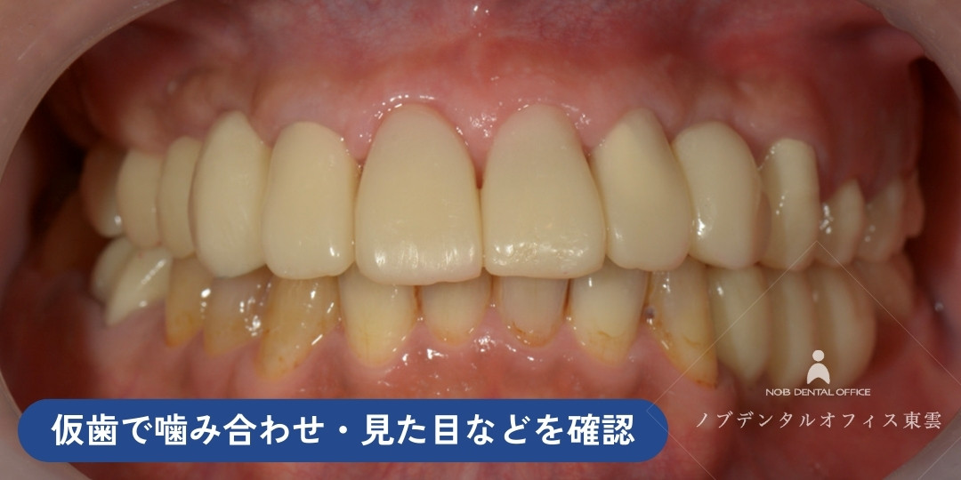 下の前歯を矯正し、仮歯の状態で上下の噛み合わせや見た目、清掃性などを確認していく写真