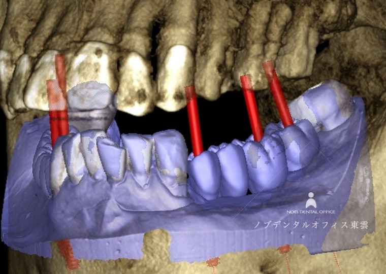 CTデータとワックスアップ情報を重ね合わせ、大事な神経や血管を傷つけないように、安全性を考えたインプラント埋入位置のシミュレーションイメージ図