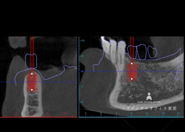 重要な血管も高精度なCTデータで写し出したデータ。