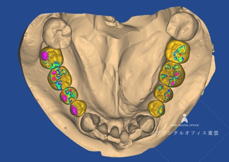 黄色い箇所にインプラントが入ることがシミュレーションでわかる
、診断用のワックスアップのデータ。