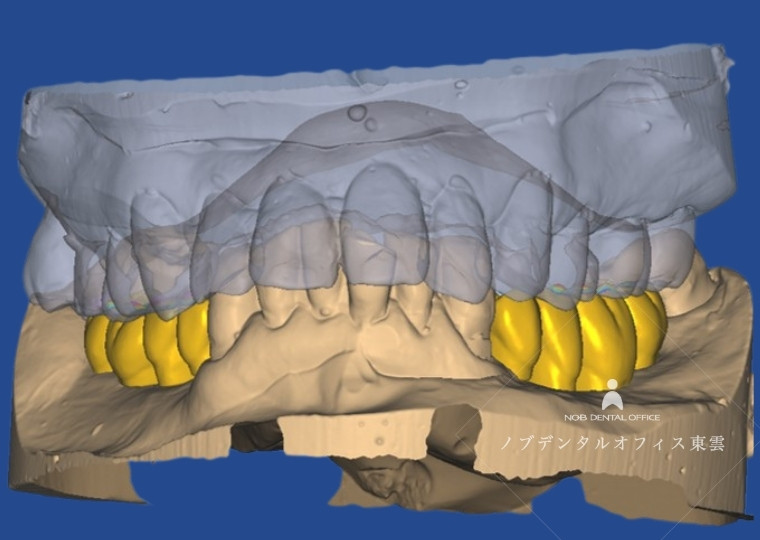 ワックスアップで趣味レーションした噛み合わせのイメージデータ